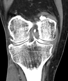 Figure 5 for case Medial meniscus tear ( RID2772 )